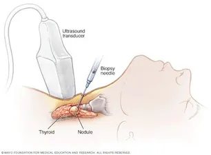 biopsy